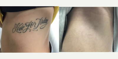 35-44 year old woman treated with Tattoo Removal, PicoWay - This 36-year-old patient wanted to remove her tattoos. To do so, 11 sessions of PicoWay were performed. Her after photos are shown 3 months after her 10th session.