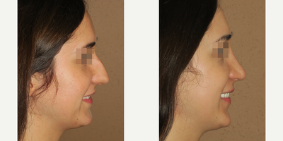 Woman treated with Rhinoplasty - Woman treated with Rhinoplasty