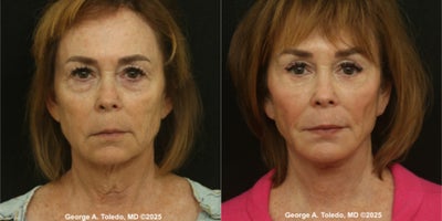 65-74 year old woman treated with Facelift, Brow Lift, Eyelid Surgery, Dermabrasion - In October 2025, a our lovely female patient underwent a series of cosmetic procedures with board certified plastic surgeon Dr. George A. Toledo in Dallas, TX. The patient experienced a remarkable transformation after receiving an Upper and Lower Blepharoplasty, Facelift, Brow Lift, and Upper Lip Dermabrasion. The outcome was a rejuvenated appearance with enhanced features and improved skin texture. Dr. Toledo's expertise and precision were evident in the patient's radiant and natural-looking results, boosting her confidence and leaving her deeply satisfied with the outcome.