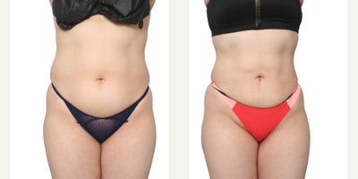 35-44 year old woman treated with Smart Lipo - Lipo 360 + BBL. Never been pregnant. Power assisted liposuction of the abdomen, flanks, and back with ultrasound-guided fat transfer to buttocks and hips.