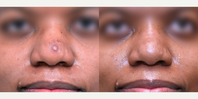 25-34 year old female treated with Microneedling RF - Morpheus8 RF Micro-needling