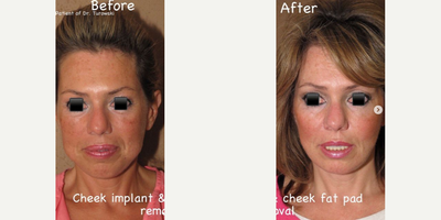 Woman treated with Buccal Fat Removal - Here we did a cheek implant to lift the cheeks and give a more youthful projection to the face as well as buccal fat pad removal which removes excess fat from inside of the cheeks.