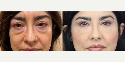 Woman treated with Eyelid Surgery - Woman treated with Eyelid Surgery