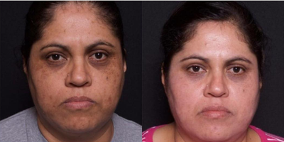 Woman treated with TCA Peel - Woman treated with TCA Peel