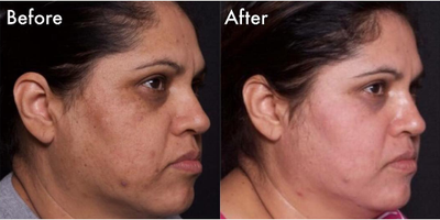 Woman treated with TCA Peel - Woman treated with TCA Peel