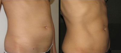 Vaser Liposuction - Vaser Hi Def abdomen and waist. This patient underwent Vaser Hi Def on the abdomen and waist.