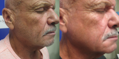 65-74 year old man treated with Sylfirm X - Patient with hyperpigmentation before and after 3 Sylfirm X microneedling treatments. After photo 1 month post procedure. Neck laxity
