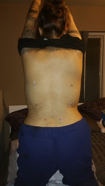 37 8 Kids Lipo Fat Transfer Bbl - Ontario, CA - Brazilian ...