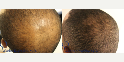 25-34 year old man treated with PRP for Hair Loss - PRP treatment