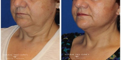 65-74 year old woman treated with Facelift, Neck Lift - Patient wanted to get rid of facial laxity and jowls.
