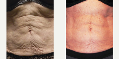 55-64 year old woman treated with Venus Legacy - Treated with Venus Legacy