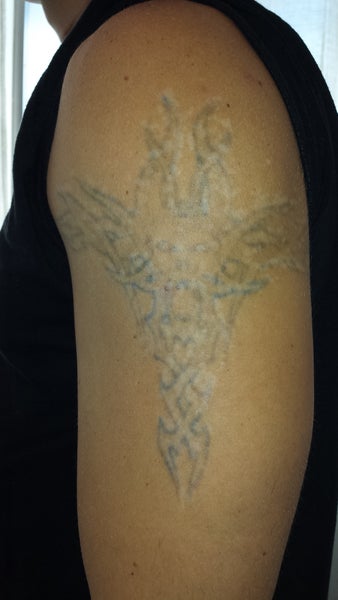 tattoo removal beverly hills ca picosure review tattoo removal beverly hills ca picosure review