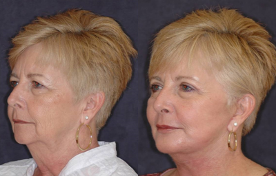 55-64 year old woman treated with Chemical Peel - facelift, 35% tca peel, blepharoplasty, smas to lips