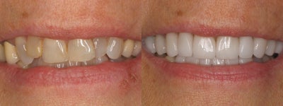 12 Porcelain Veneers -
Patient recieved 12 porcelain veneers