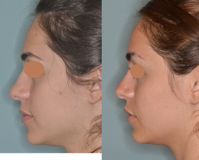 18-24 year old woman treated with Rhinoplasty - Female patient who was unhappy with the appearance of her nose. Her main concerns included the wide, bulbous tip and the slight nasal hump on her profile. A primary rhinoplasty was performed which included the reduction of the hump, placement of spreader grafts, a caudal septal extension graft, and tip graft. Seen here are her 3 month post-op photos. Patient wanted a natural-appearing tip with refinements. Post-op photos taken from her frontal, profile, and base view show the refinements made with a primary rhinoplasty procedure.