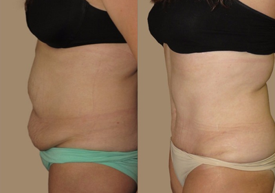 35-44 year old woman treated with Tummy Tuck - Tummy Tuck