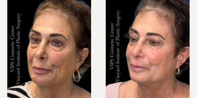55-64 year old woman treated with CoolPeel, Skin Lightening, CO2 Laser, Skin Rejuvenation, IPL - This patient underwent a single-session combination treatment using CoolPeel laser resurfacing and the Elluminate Advanced Photofacial with IPL to address sun damage, hyperpigmentation, enlarged pores, and overall skin dullness.Her photos show brighter, more even-toned skin with softening of discoloration across the cheeks, temples, and lower face. Fine lines appear smoother, the complexion looks clearer and more refined, and the surface texture shows a noticeable boost in radiance and uniformity. By pairing fractional CO resurfacing with a multi-wavelength photofacial, this treatment targets both superficial and deeper pigment irregularities while stimulating collagen for long-term rejuvenation.This single combined session delivered a healthier, more refreshed complexion with improved clarity, reduced pigmentation, and a smoother overall appearancean excellent option for patients seeking visible skin renewal with little to no downtime.