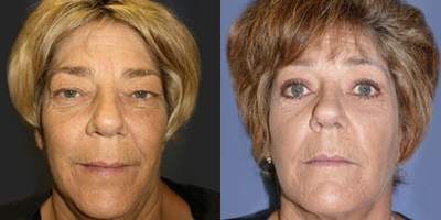 55-64 year old woman treated with Eyelid Surgery - eyelid lift