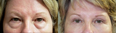 45-54 year old woman treated with Eyelid Surgery - Upper and Lower Eyelid Procedure