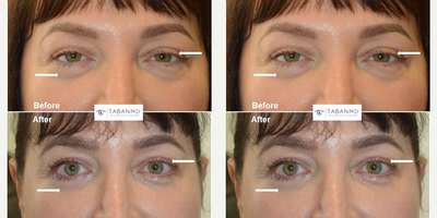 Ptosis surgery and quad-blepharoplasty. - Middle age woman underwent droopy upper eyelid ptosis surgery, lower blepharoplasty, and upper blepharoplasty. Note natural results with more refreshed appearing eyes.