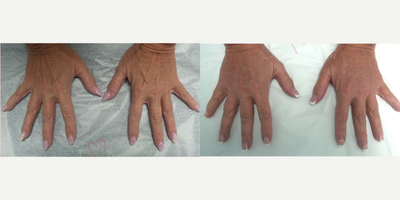55-64 year old woman treated with Hand Rejuvenation - Hand rejuvenation with dermal filler injection (Radiesse, Juvederm) using micro-cannula technique