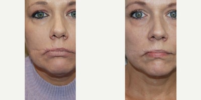 Silikon-1000 Before & After: Improved Depressed Cheek Scar Following Gunshot Injury - Our beautiful patient came to us feeling out of options, and depressed. She had suffered a severe gunshot wound to the right side of her face, which was through and through, and despite a meticulous repair, this led to an unsightly depressed scar. This scar caused her significant emotional distress, as her childrens peers would sometimes make fun of her, which only added to her severe dissatisfaction. Recognizing her situation, I offered to donate my services to help restore her confidence. Since the cheek moves, with speaking or chewing, developing a widened scar is the norm, not the exception, so I did not recommend scar revision. Instead, I recommended permanently filling the depressed area with microdroplet Silikon-1000 injections. Since the patient was very emotional about this, she asked us to perform a ceiling demonstration, and when she looked in the mirror afterwards, I could see she was thrilled. Since microdroplet Silikon-1000 injections are permanent and irremovable, if I am uncertain whether or not we can achieve a desired result, or if a patient would like to see how they will look after Silikon-1000, we simply inject salt water, and that leads to a desired result that will last for several hours. One week later, we proceeded with a silikon-1000 treatment, and one month after that we did another. She is seen in her photographs and in her video, two months after her initial treatment. We are all extremely pleased with her results, and I am beyond grateful that she has allowed us to post her story and her outcome.