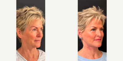 Woman treated with Neck Lift - Woman treated with Deep Plane Facelift, Neck Lift, Facial Fat Transfer, and Lip Lift.