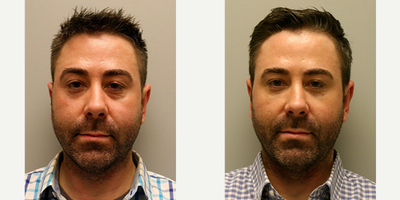 Man treated with Restylane - Male in his 30s was concerned with the tired appearance to the lower eyes particularly the hollows and bags. He did not want to undergo lower eyelid plastic surgery at this time and opted for a non-surgical eye lift in our Palo Alto office. Topical numbing cream was used for anesthesia and the area of under eye hollows was treated with a Restylane injection for a non-surgical blepharoplasty or eyelid lift.