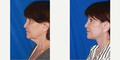 64 year old woman treated with Deep Plane Facelift, Neck Lift - 64 year old patient after deep plane face and neck lift