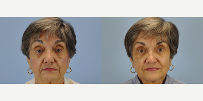 75 and up year old woman treated with Ptosis Surgery - This 77 year old had corrective surgery for levator ptosis, which allowed her eyelids to fully open and expand her visual field to a fuller capacity.