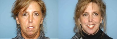 Face Lift & Chin Implant - Face Lift & Chin Implant