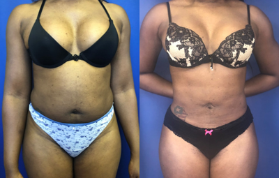 25-34 year old woman treated with Abdominal Etching - A woman in her 30s is shown 5 months after abdominal etching.