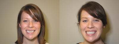 2 Porcelain Veneers -
Patient recieved 2 porcelain veneers.