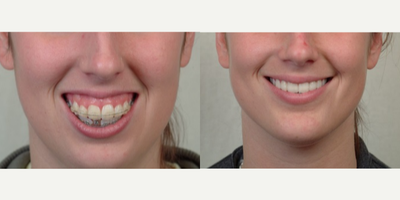 Orthognathic Surgery and gummy smile change - excellent smile line with reduction of gummy smile