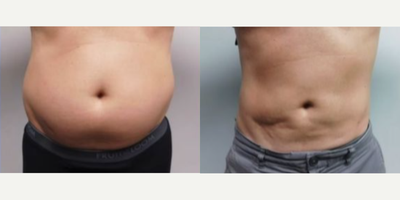 Man treated with Liposuction - This gentleman is 6 months after his liposuction and Renuvion procedure. Notice his right appendectomy scar before the surgery and where it ends up after the surgery. This is a testament to how much Renuvion actually does contract the skin!