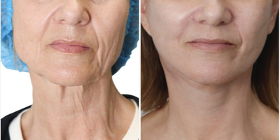 Woman treated with Deep Plane Facelift - Woman treated with Deep Plane Facelift