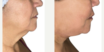 Woman treated with Deep Plane Facelift - Woman treated with Deep Plane Facelift