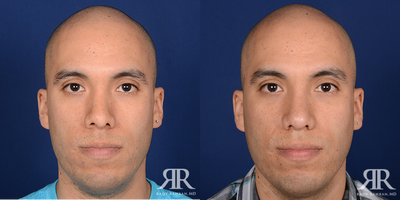Rhinoplasty - Rhinoplasty