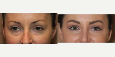 25-34 year old woman treated with Eyelid Surgery - lower blepharoplasty