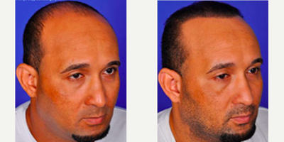 Man treated with Hair Loss Treatment - Man treated with Hair Loss Treatment throughFUE Hair Transplant (SmartGraft)
