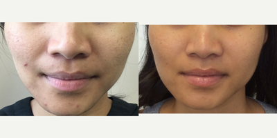 25-34 year old woman treated with Microneedling - Microneedling procedure for acne scarring. Photos taken before and after 1 month apart after first visit.