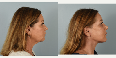 55-64 year old woman treated with CO2 Laser, Facelift, Eyelid Surgery, Neck Lift - This patient had the following procedures: mini facelift, neck lift, lower blepharoplasty, fractional CO2 laser. After photos are 2 months post op.