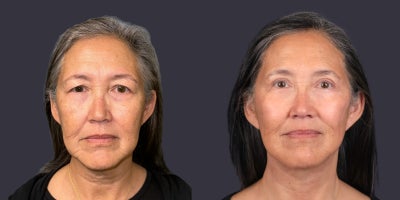55-64 year old woman treated with Chemical Peel, Eyelid Surgery, Facelift, Lower Facelift, Neck Lift, TCA Peel, Velashape - 63 year old woman who is 5'3 tall and weighs 153 pounds. She had an upper eyelid lift, TCA chemical peel around the eyes, and a lower face and neck lift. Her after photos are at 6 months.