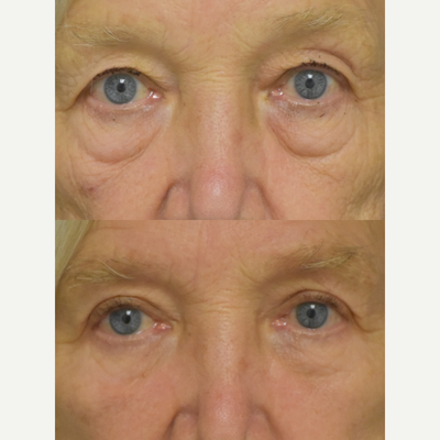 75 and up year old woman treated with Double Eyelid Surgery - 75 and up year old woman treated with Double Eyelid Surgery