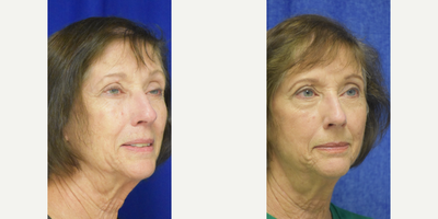 65-74 year old woman treated with Eyelid Surgery, Ptosis Surgery - 65-74 year old woman treated with Eyelid Surgery, Ptosis Surgery