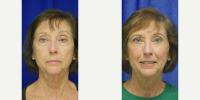 65-74 year old woman treated with Eyelid Surgery, Ptosis Surgery - 65-74 year old woman treated with Eyelid Surgery, Ptosis Surgery