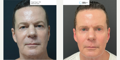 55-64 year old man treated with Facelift - Macs Face Lift Surgery