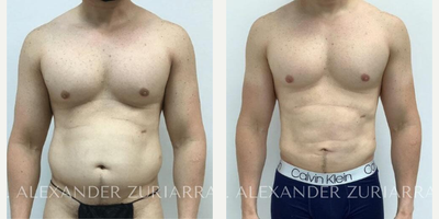 47 year old man treated with Liposuction - 47 year old man treated with Liposuction
