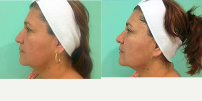 45-54 year old woman treated with Thermage - Before and after results that show the improvement of the jaw line contour, skin tone and texture.