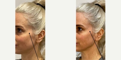 35-44 year old woman treated with Dermal Fillers - 1 syringe of Voluma for temple hollowin